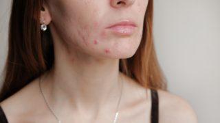 Sivilcelerden kurtulmak için bitkilerden destek alabilirsiniz! Bu yöntemle geçmeyen sivilcelerden anında kurtulabilirsiniz