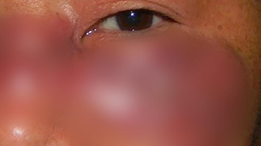 Hindistan’da koronayla birlikte patlama yapmıştı! İşte kara mantar enfeksiyonunun ürperten fotoğrafı