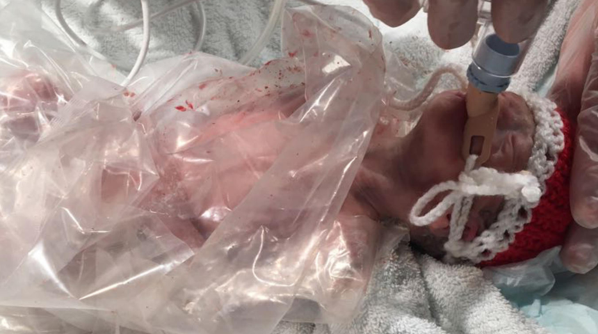 500 gram doğdu, torba içinde hayata tutundu