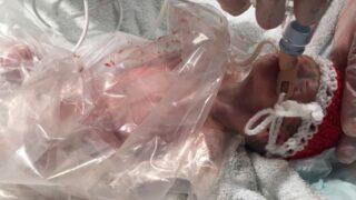 500 gram doğdu, torba içinde hayata tutundu