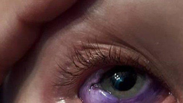 Gözünü mor renk yapmak isterken kaybetti! Kör olacak!