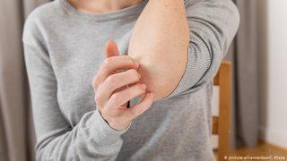 Google aramalarında yeni trend: Uyuz hastalığı