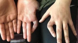 Elini hızara kaptırdı: Ömür boyu bir elini kullanamama durumu var