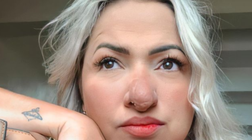 Burnundaki t&uuml;m&ouml;rden dolayı hayatı boyunca k&ouml;t&uuml; yorumlara maruz kalan Laudiane Fernandes&rsquo;in ilham veren hikayesi