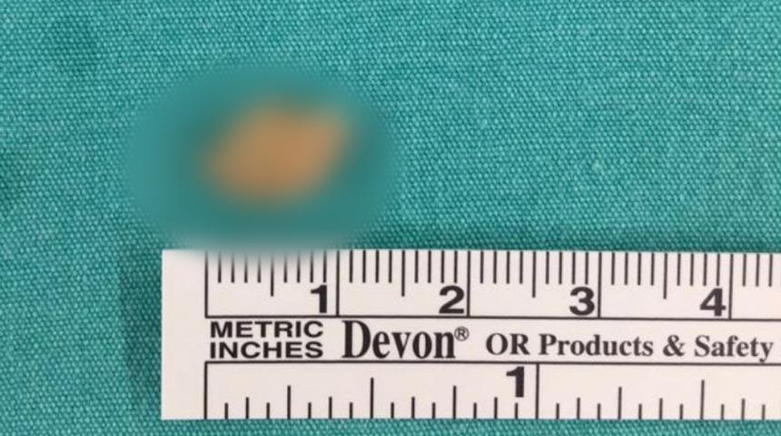 Gerçeği 10 yıl sonra öğrendi; bademcik iltihabı dediler taş çıktı