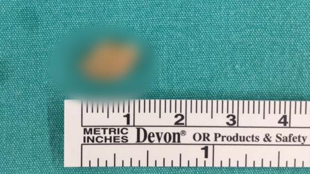 Gerçeği 10 yıl sonra öğrendi; bademcik iltihabı dediler taş çıktı