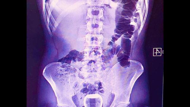 Hacamat yaptırırken anüsüne bardak kaçtı