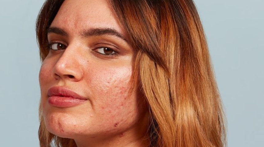 Sivilceleriyle güzellik algısını baştan yazdı! Kendisini saklamayı asla tercih etmedi