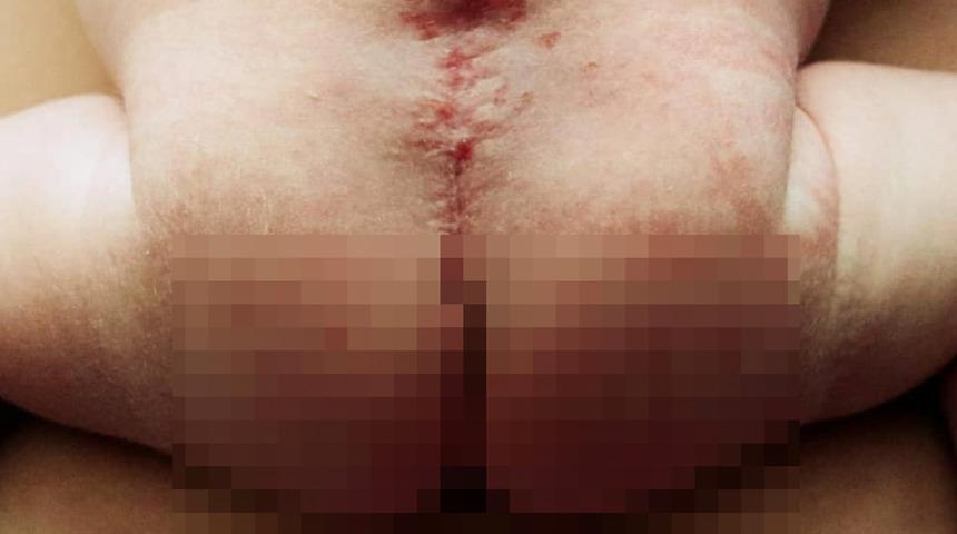 Anne karnındayken ameliyat edilen mucize bebek! ''Hamileliğini sonlandıralım'' denildi