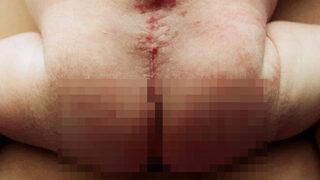 Anne karnındayken ameliyat edilen mucize bebek! ''Hamileliğini sonlandıralım'' denildi