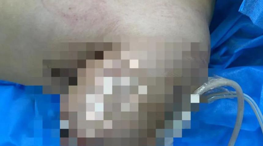 &Ouml;l&uuml;me bile neden olabiliyor! Balık ayıklarken enfeksiyon kaptı, kolu kesildi