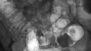 Mideye dışkı gitmesine neden oluyor: Bağırsak fistülü nedir, nasıl tedavi edilir?