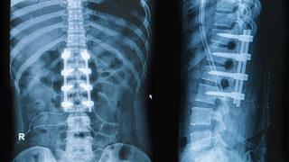 Omurga platinleri, vida ameliyatları ve riskleri nelerdir?