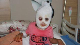 Kaynar suyu üzerine döken çocuk feci şekilde yandı