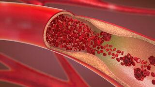 Ağrısız tedavi doğal bypass nedir, nasıl yapılır?
