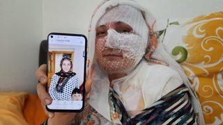 Eşinin kızgın yağ ile yaktığı kadından yürek yakan feryat: Ölmek istemiyorum