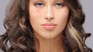 Doku yenileme tedavisi nedir, nasıl yapılır?