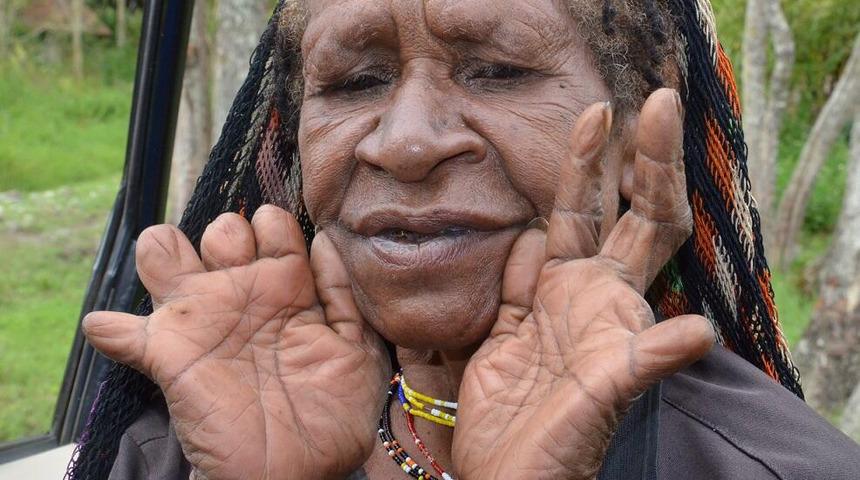 Böyle korkunç gelenek görülmedi! Yas için parmaklarını kesen ilginç kabile: Dani kabilesi