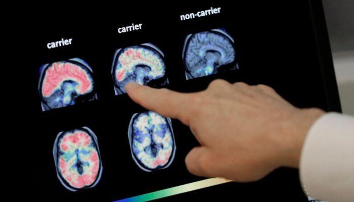 ABD’den Alzheimer İlacına Tarihi Onay