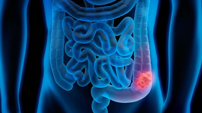 IBS, hayatımızın olumsuz bir parçası