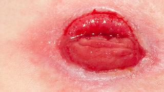 Abdomino-perineal rezeksiyon nedir? Bağırsağın dışarıya alınması ameliyatı hangi durumda yapılır?