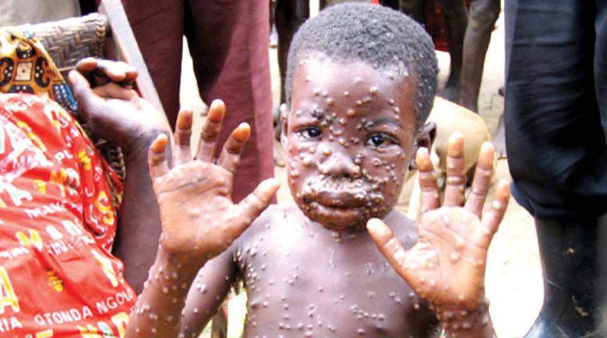 Maymun Çiçeği Virüsü nedir, nasıl bulaşır? Monkeypox öldürür mü? Maymun Çiçeği Virüsü belirtileri neler?