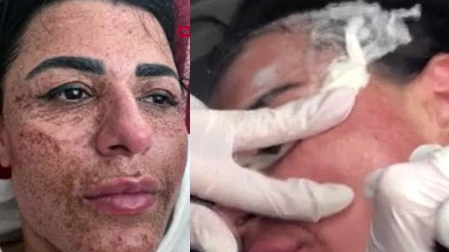 Güzellik salonunda kabusu yaşamıştı! İnanılmaz değişim: Artık aynaya bakabiliyorum