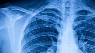 Göğüs duvarı bozukluğu nedir? Kesin tedavisi var mı?