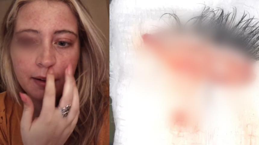 Göz kapağını köpek parçaladı, isyan etti: Sahibi bir kez aramadı