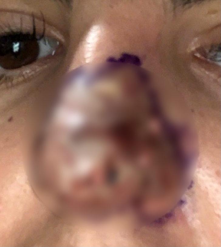 Burnuna dolgu yaptırdı, hayatı kabusa döndü: Aynaya baktığımda dehşete düştüm, burnum ölüyordu G3