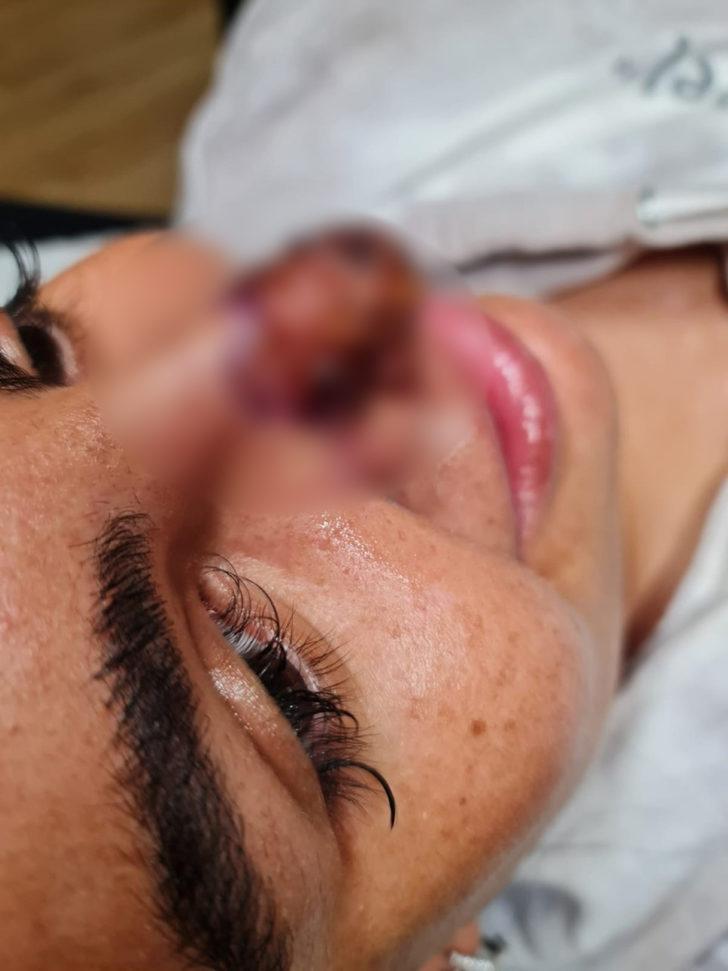 Burnuna dolgu yaptırdı, hayatı kabusa döndü: Aynaya baktığımda dehşete düştüm, burnum ölüyordu G1
