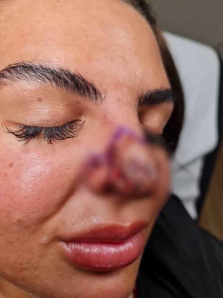 Burnuna dolgu yaptırdı, hayatı kabusa döndü: Aynaya baktığımda dehşete düştüm, burnum ölüyordu G4