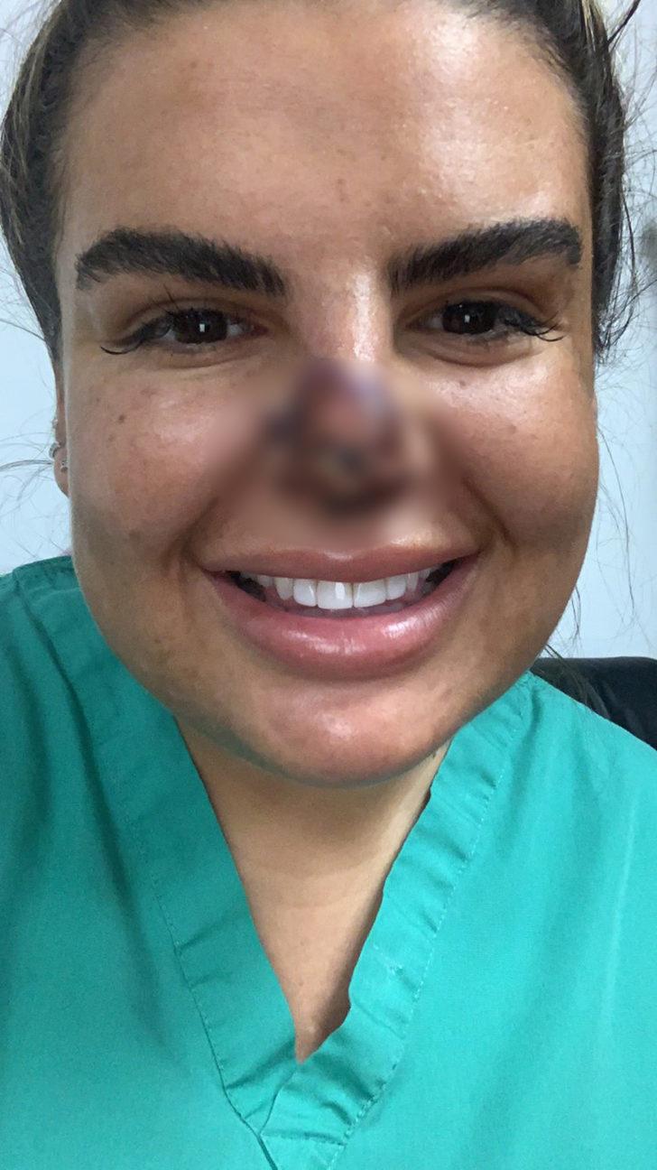 Burnuna dolgu yaptırdı, hayatı kabusa döndü: Aynaya baktığımda dehşete düştüm, burnum ölüyordu G5