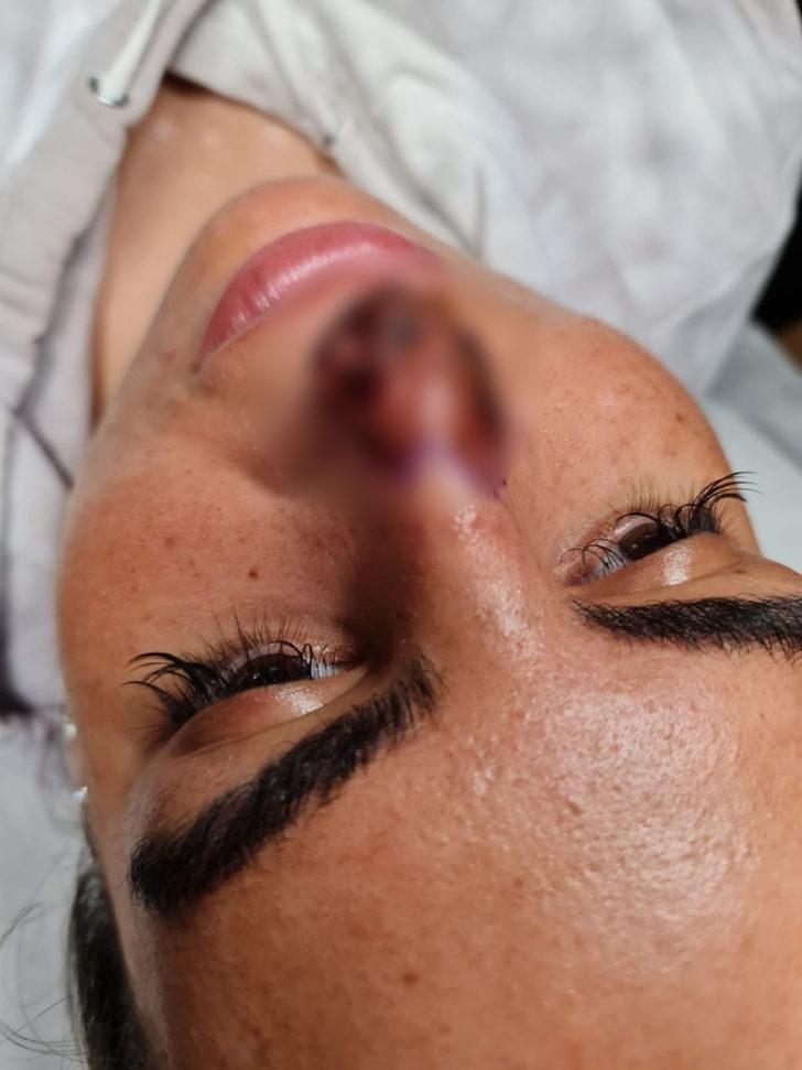 Burnuna dolgu yaptırdı, hayatı kabusa döndü: Aynaya baktığımda dehşete düştüm, burnum ölüyordu G2