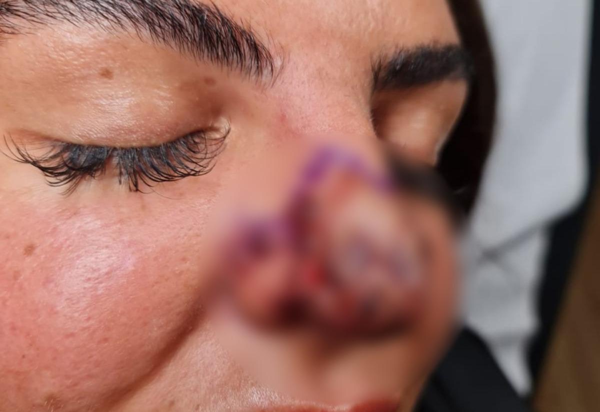 Burnuna dolgu yaptırdı, hayatı kabusa d&ouml;nd&uuml;: Aynaya baktığımda dehşete d&uuml;şt&uuml;m, burnum &ouml;l&uuml;yordu