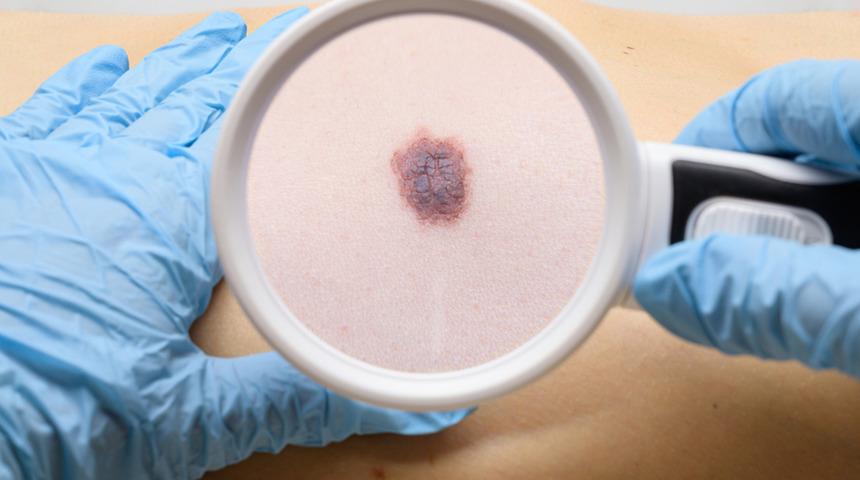 Cilt kanseri (deri kanseri) hakkında doğru bildiğiniz 10 yanlış! "Çocukluğumdan beri var" diyorsanız dikkat