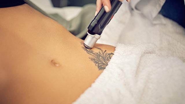 Dövme sildirme kaç seans sürer? Dövme sildirme işlemi sonrası yara oluşur mu?