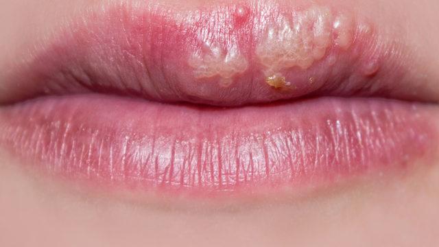 Uçuk neden çıkar, kaç günde geçer, bulaşıcı mıdır? İşte uçuk tedavisi için yöntemler