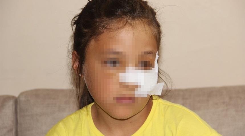 K&uuml;&ccedil;&uuml;k kız dehşeti yaşadı! Kuzeninin fırlattığı demir boru y&uuml;z&uuml;n&uuml; yaraladı