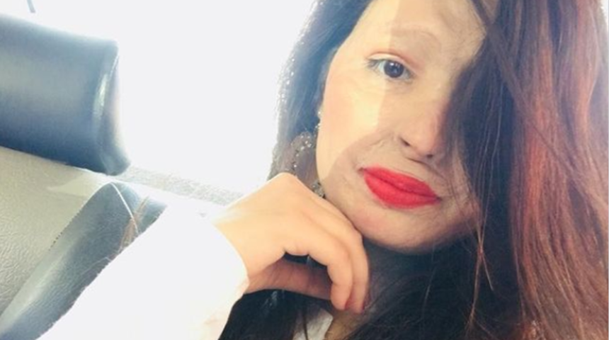 Uğradığı asit saldırısı sonucunda hayatı tamamen değişen Reshma Qureshi&rsquo;nin hikayesi bir&ccedil;ok kadına ilham kaynağı oldu