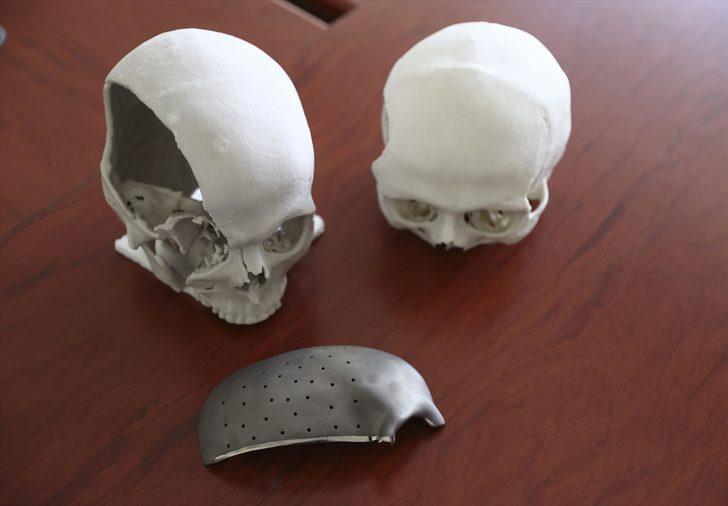 16 yaşındaki Gizemnur yapay kafatası parçalarının nakledilmesiyle hayata yeniden bağlandı G2