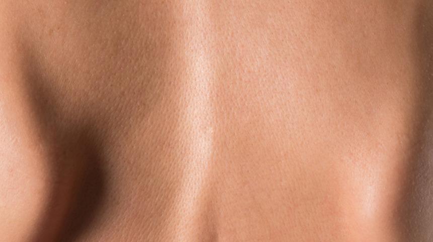 Skolyoz nedir, belirtileri nelerdir? Skolyoz tedavisinde geç kalmayın!