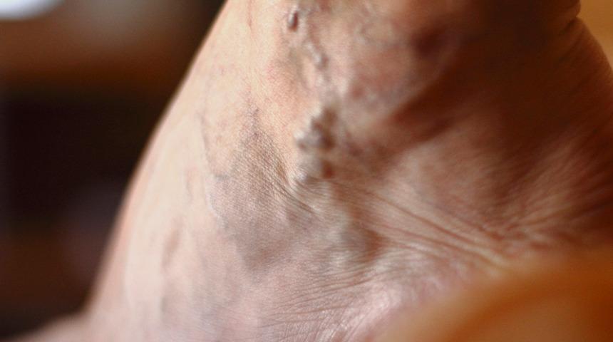 Varis tedavisinde bu y&ouml;ntemler ağrıları yok ediyor!