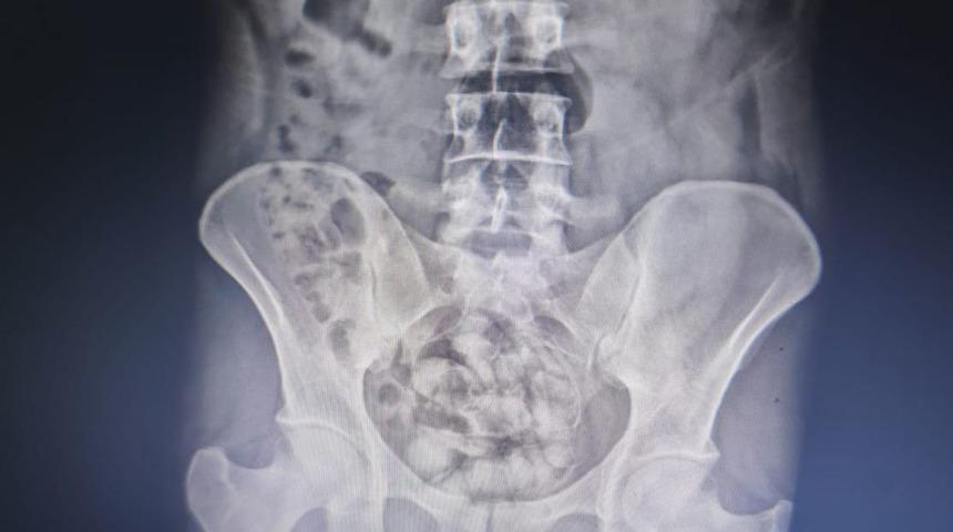 Akılalmaz yöntem! Röntgen filminde midesinden çıkanlar şoke etti