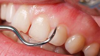 Diş eti çekilmesi tedavisi nasıl olur? Diş eti çekilmesine ne iyi gelir?