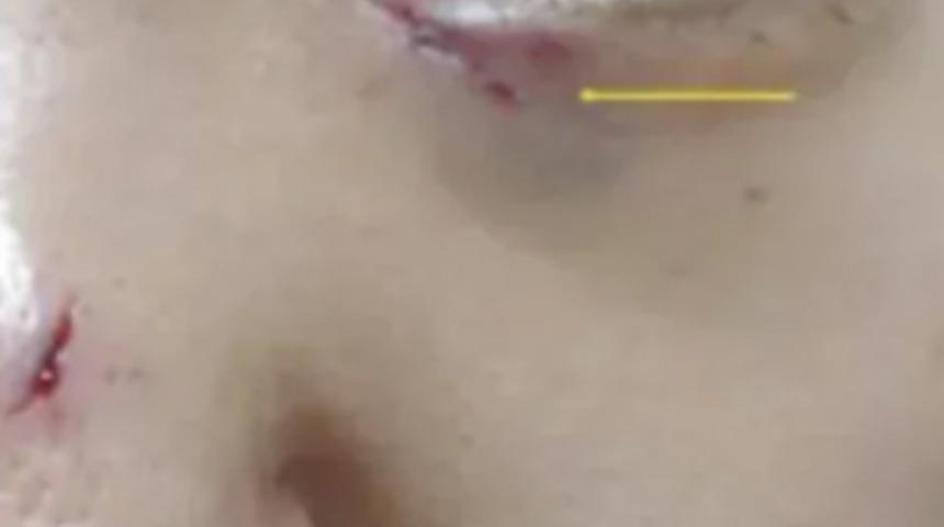 Ablasıyla tartışan kadın korkunç gerçeği haftalar sonra öğrendi! Burnundan ve gözünden çıkarıldı