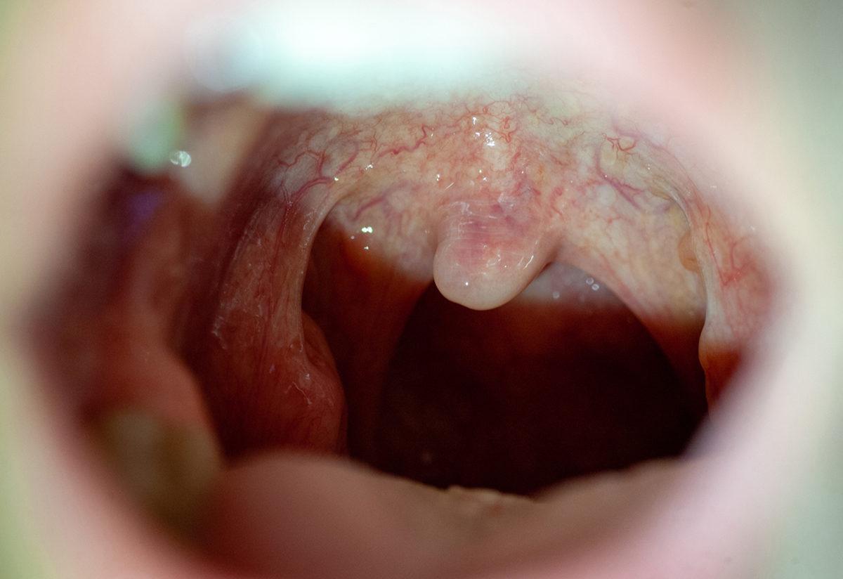 Images of inside of mouth