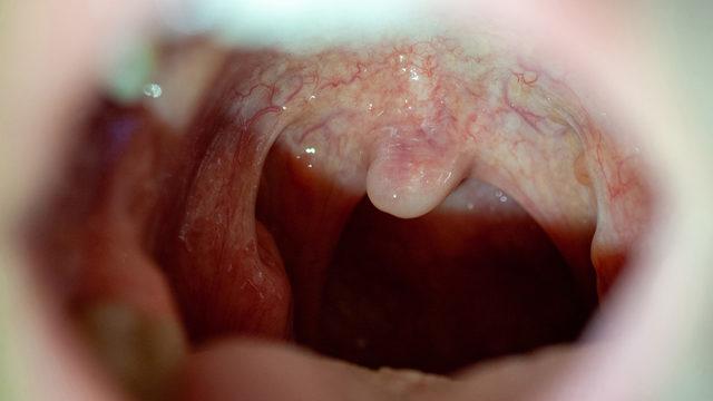 Bademcik iltihabına ne iyi gelir? Bademcik iltihabı belirtileri nedir, tedavisi için ne yapılmalı?