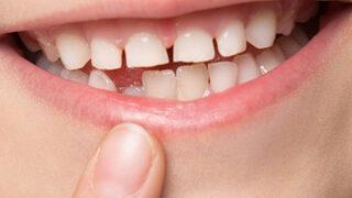 Kalıcı dişler ne zaman çıkar? Çarpık olmasının nedeni nedir? Tırtıklı çıkıyorsa...