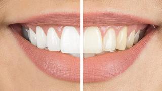 Diş beyazlatma yöntemleri ile istediğiniz gülüşe sahip olabilirsiniz! 